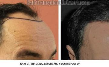 Hair transplantation surgery before and after pictures