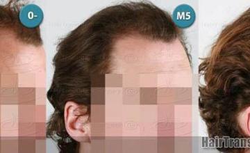  before and after images