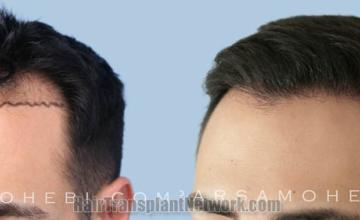 Hair transplantation surgery before and after images