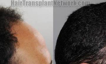 Hair transplantation procedure before and after results