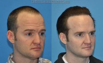Hair transplantation surgery before and after images