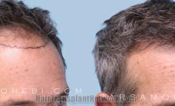 Hair transplantation surgery before and after images