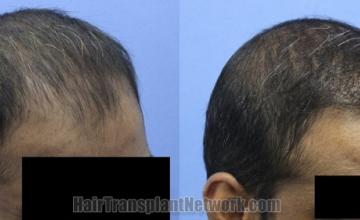 Hair transplantation surgery before and after images