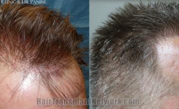 Hair transplantation surgery before and after images