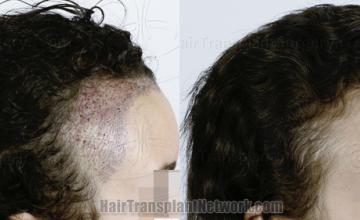 Hair transplantation surgery before and after images