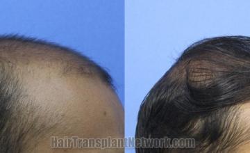 Hair transplantation surgery before and after images