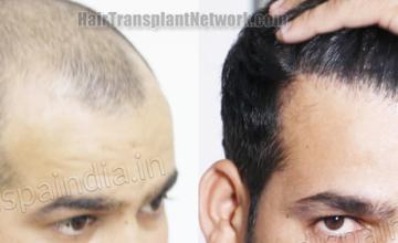 Hair transplantation surgery before and after images