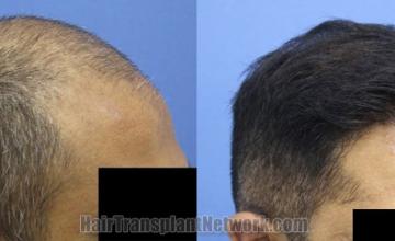 Hair transplantation surgery before and after images