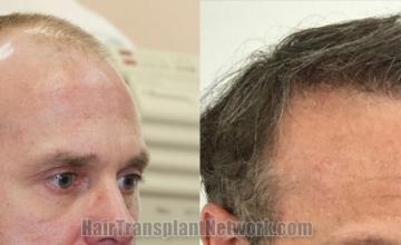 Hair transplantation surgery before and after images