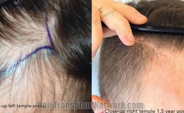 Hair transplantation surgery before and after images