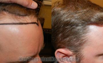 Hair transplantation surgery before and after images