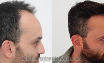 Hair transplantation surgery before and after images