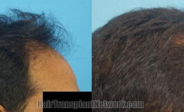 Hair transplantation surgery before and after images