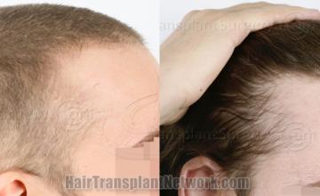 Hair transplantation surgery before and after images