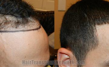 Hair transplantation surgery before and after images