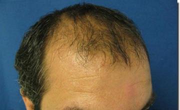 Hair restoration procedure results