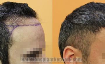 Hair transplantation surgery before and after images