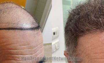 Hair transplantation surgery before and after images