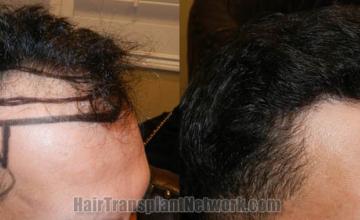 Hair restoration procedure before and after pictures