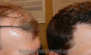 Hair transplantation surgery before and after images