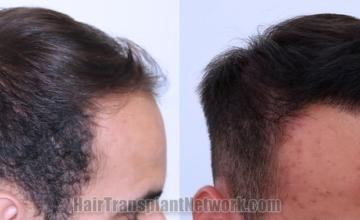 Hair transplantation surgery before and after images