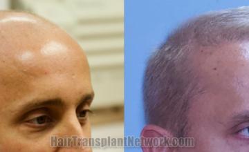 Hair transplantation surgery before and after images
