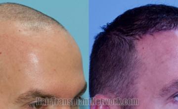 Hair transplantation surgery before and after images
