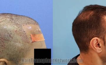 Hair restoration procedure before and after pictures