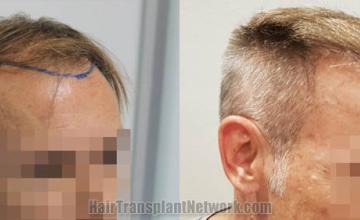 Hair transplantation surgery before and after images