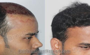  before and after result photographs