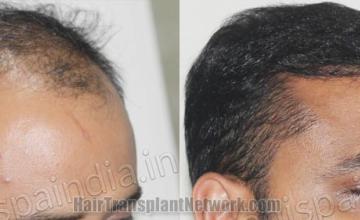 Hair restoration procedure before and after pictures