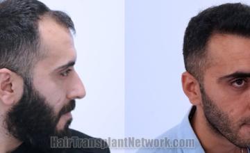 Hair transplantation surgery before and after images