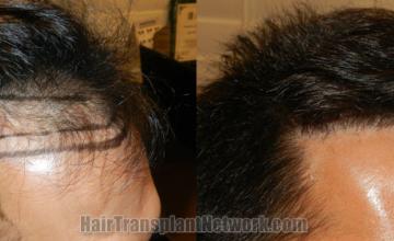 Hair transplantation surgery before and after images