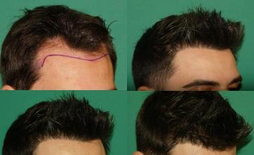 Hair transplantation procedure before and after results