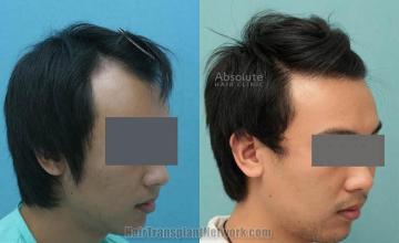 Hair transplantation procedure before and after results