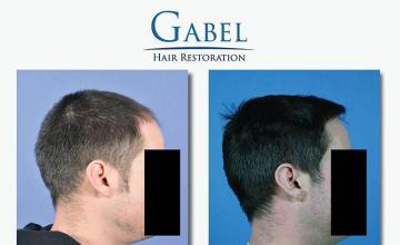 Hair transplantation procedure before and after results