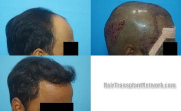 Hair transplantation procedure before and after results