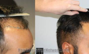 Hair transplantation surgery before and after images