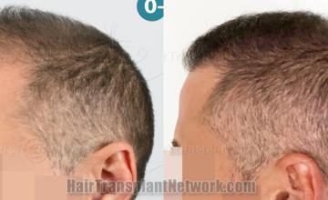  before and after result photographs