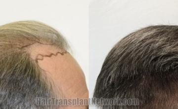 Hair transplantation surgery before and after images