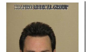 Hair restoration procedure results