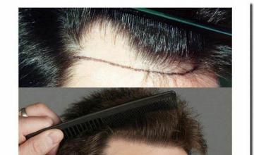 Hair restoration procedure results