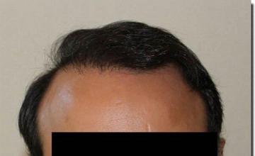 Hair restoration procedure results