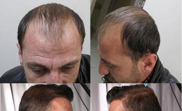 Hair restoration surgery before and after photographs