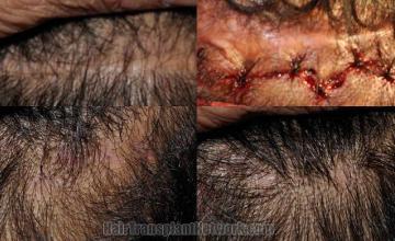 Hair transplantation surgery - Scar Revision