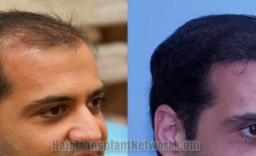 before and after result photographs