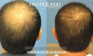 Hair transplantation surgery before and after photos