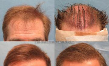 Front view - Before and after transplantation surgery
