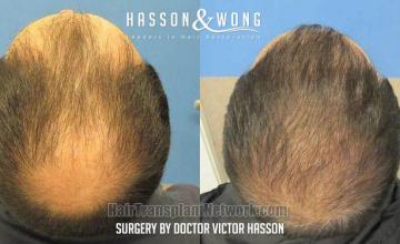 Surgical hair transplantation result photographs