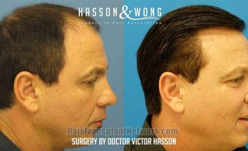 Hair transplant surgery before and after pictures